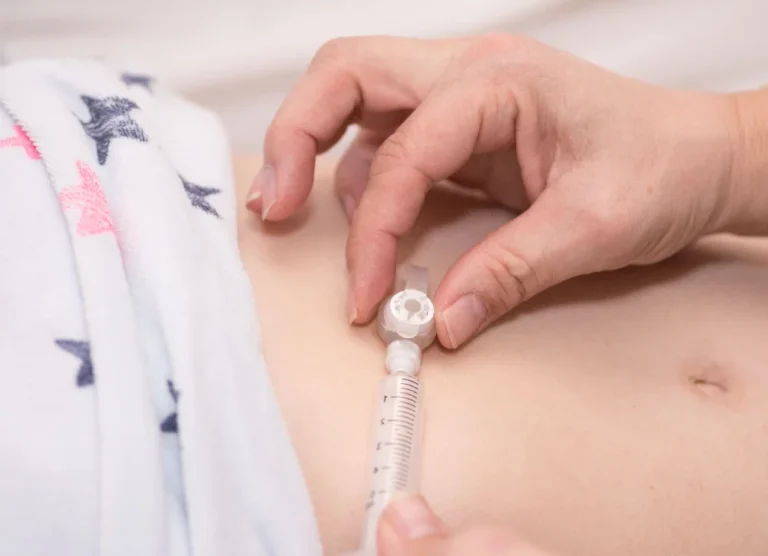 Photo: Understanding PEG Feeding